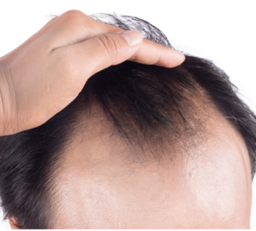 hair loss
