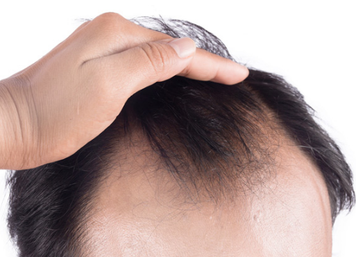 hair loss