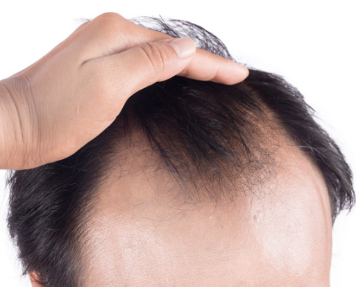 hair loss