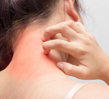 Does Jock Itch Really Go Away?