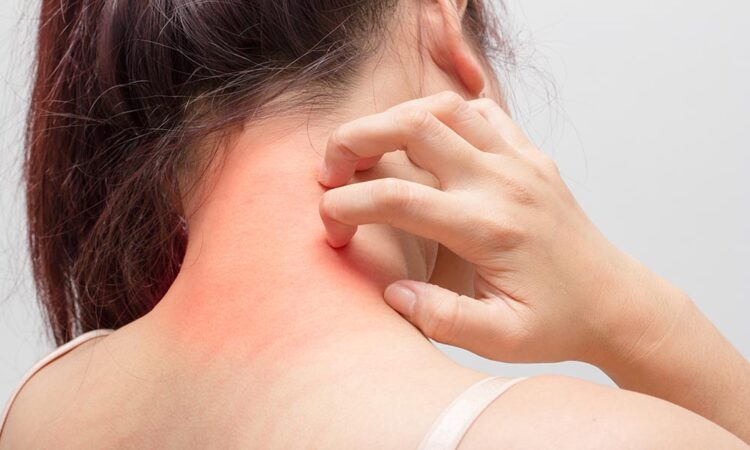 Does Jock Itch Really Go Away?