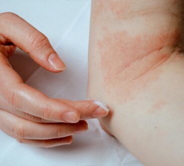 Eczema