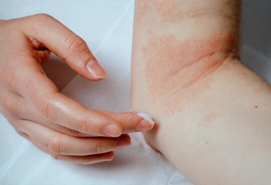 Eczema