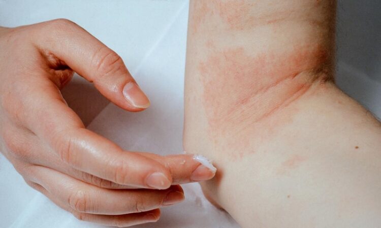 Eczema