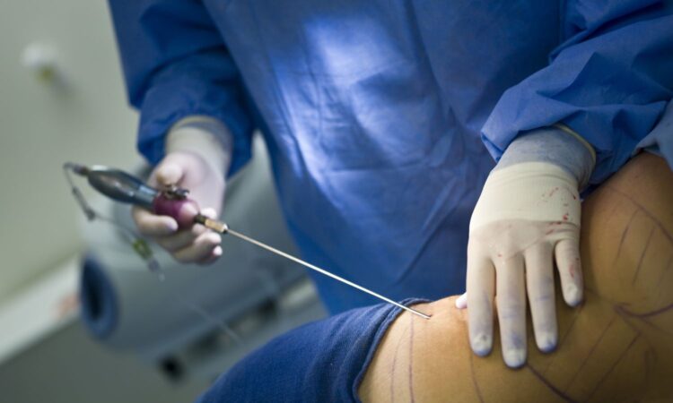 Liposuction Recovery: Tips for a Speedy Healing Process