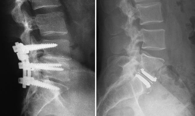 Cervical Disc Replacement vs. Fusion Surgery: Which One Is Better for You?