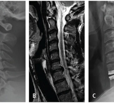 Cervical Disc Replacement vs. Fusion Surgery: Which One Is Better for You?