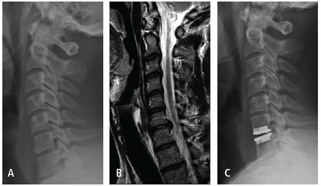 Cervical Disc Replacement vs. Fusion Surgery: Which One Is Better for You?