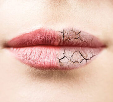 Tips to Beautify Dark, Dry Lips