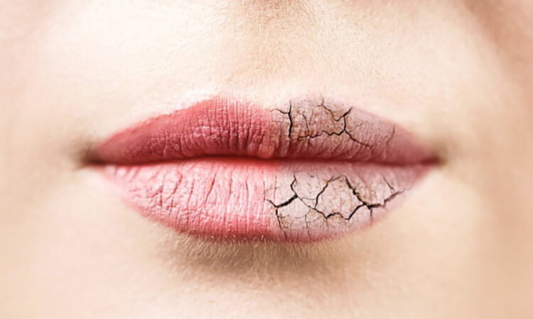Tips to Beautify Dark, Dry Lips