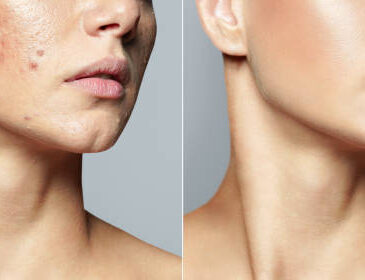 Acne scar treatment solution