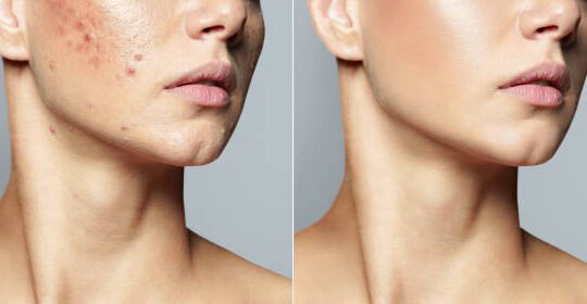 Acne scar treatment solution