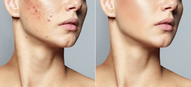 Acne scar treatment solution
