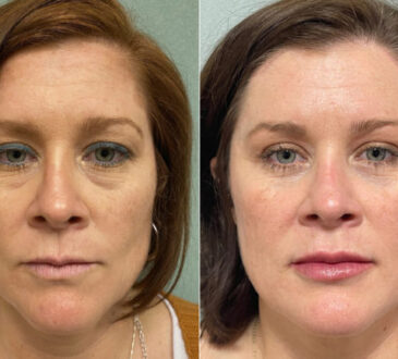 Blepharoplasty
