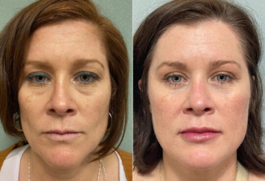 Blepharoplasty