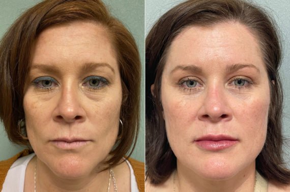 Blepharoplasty