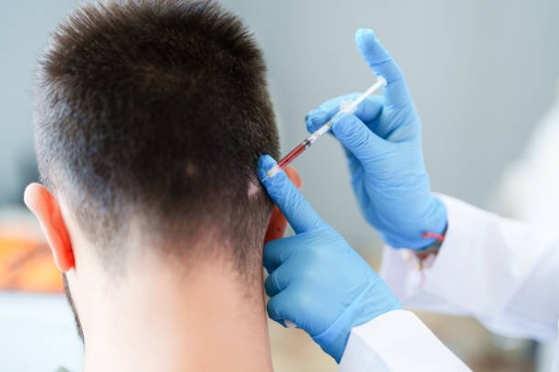 prp for male hair loss