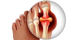 Why Gout Symptoms Are Often Misdiagnosed—and How a Gout Doctor Near Me Can Help